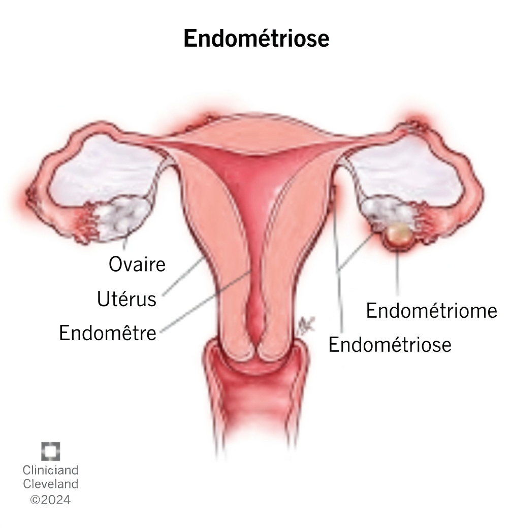 Qu’est-ce que l’endométriose et pourquoi chaque femme devrait-elle la connaître ?