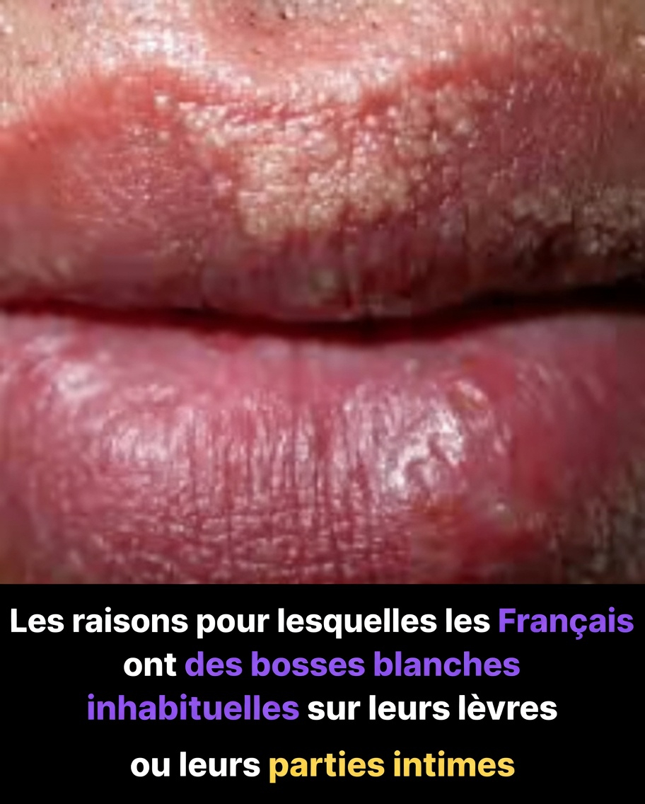 Pourquoi remarque-t-on de petites bosses blanches inhabituelles sur les lèvres ou les parties intimes ? Un guide simple