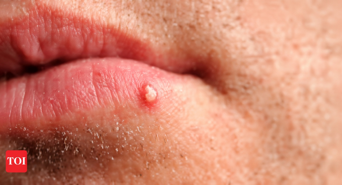 Pourquoi remarque-t-on de petites bosses blanches inhabituelles sur les lèvres ou les parties intimes ? Un guide simple