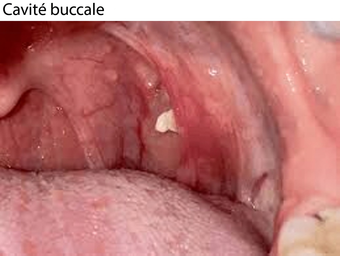 Quelle est cette petite boule sortie de votre gorge après avoir éternué ? Comprendre les calculs amygdaliens