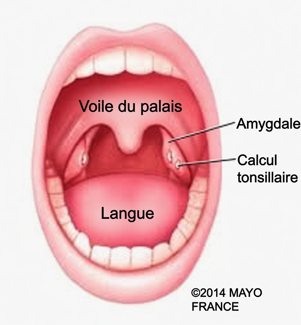 Quelle est cette petite boule sortie de votre gorge après avoir éternué ? Comprendre les calculs amygdaliens