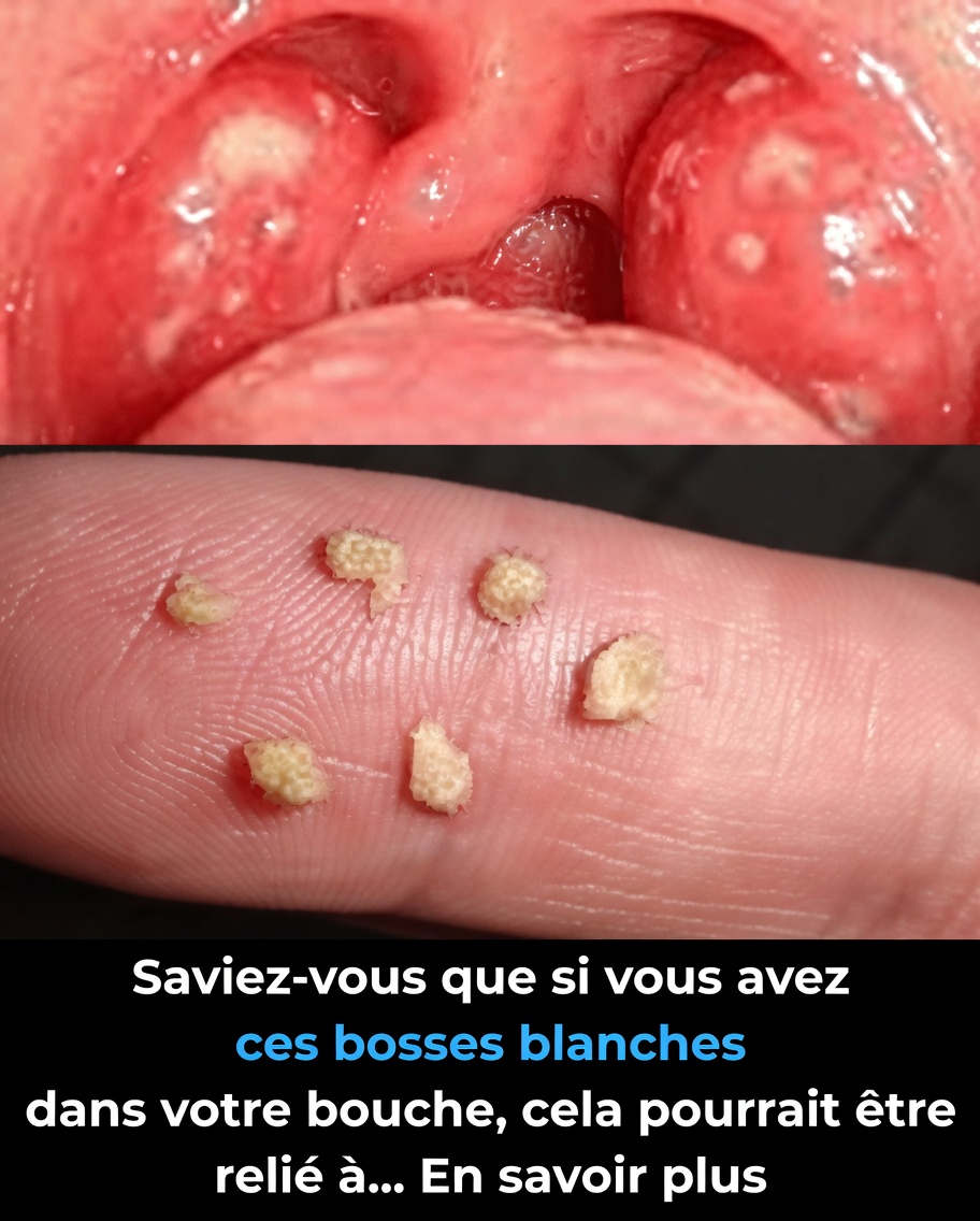 Découvrez ce que pourraient signifier ces petites bosses blanches dans votre bouche et les habitudes quotidiennes à essayer