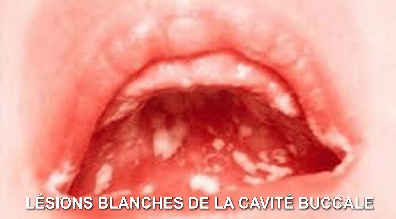 Découvrez ce que pourraient signifier ces petites bosses blanches dans votre bouche et les habitudes quotidiennes à essayer