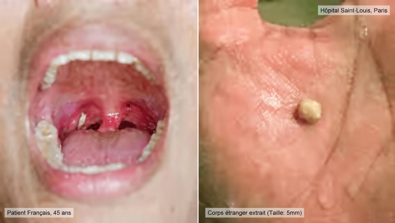 Les calculs amygdaliens : ce qu’ils sont et pourquoi ils pourraient être à l’origine de votre mauvaise haleine persistante