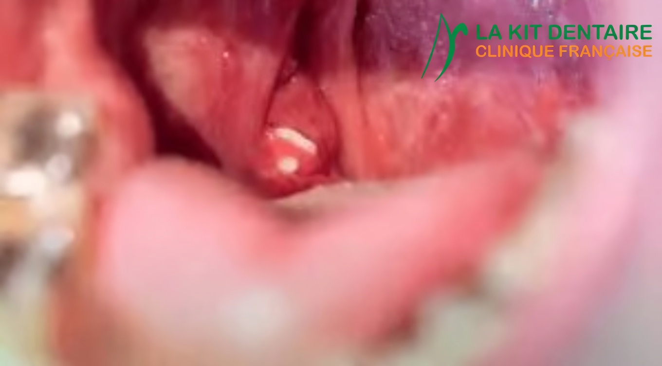 Les calculs amygdaliens : ce qu’ils sont et pourquoi ils pourraient être à l’origine de votre mauvaise haleine persistante