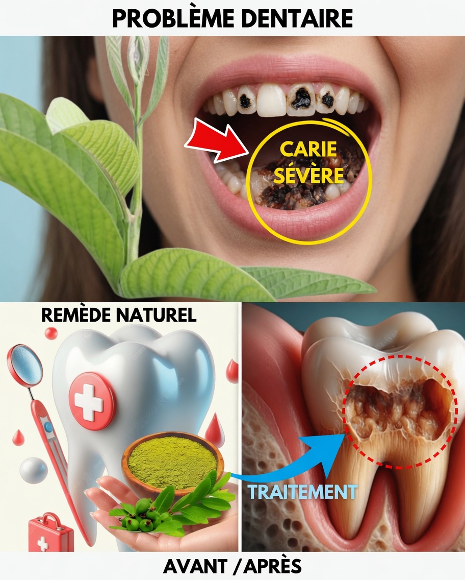 Les 3 meilleures façons de traiter la carie dentaire avec des feuilles de goyavier – simples et économiques