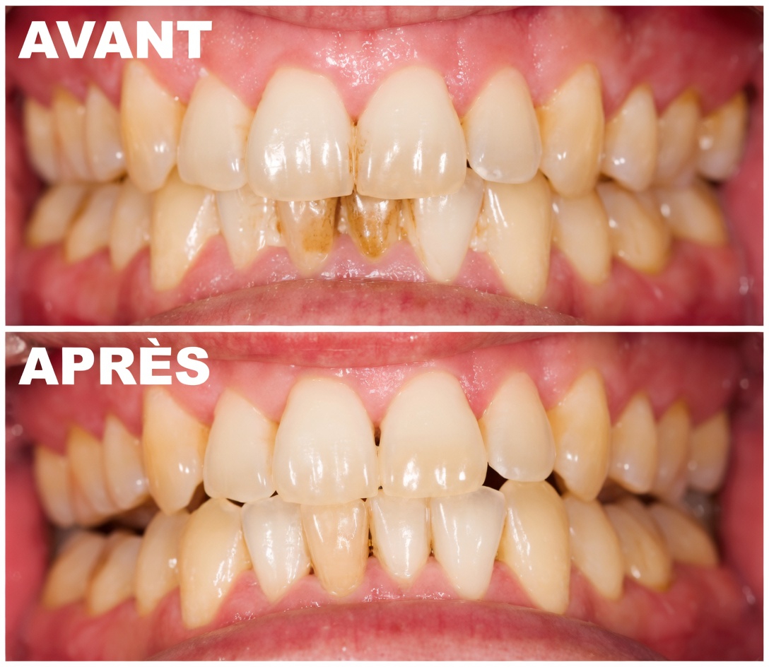 Les coquilles d’œuf transforment les dents jaunes en blanc nacré en seulement 5 minutes
