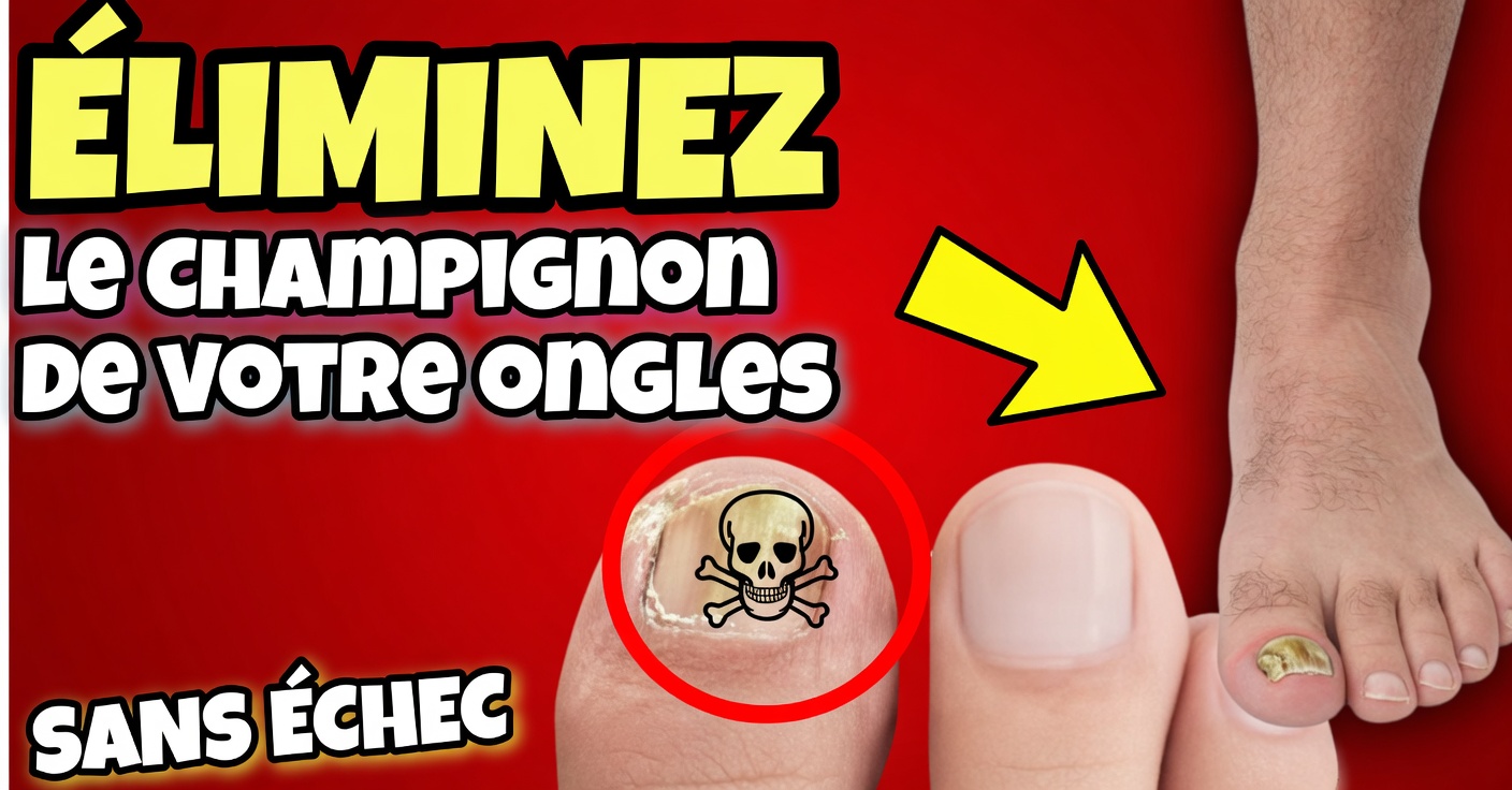 Vinaigre pour les mycoses des ongles