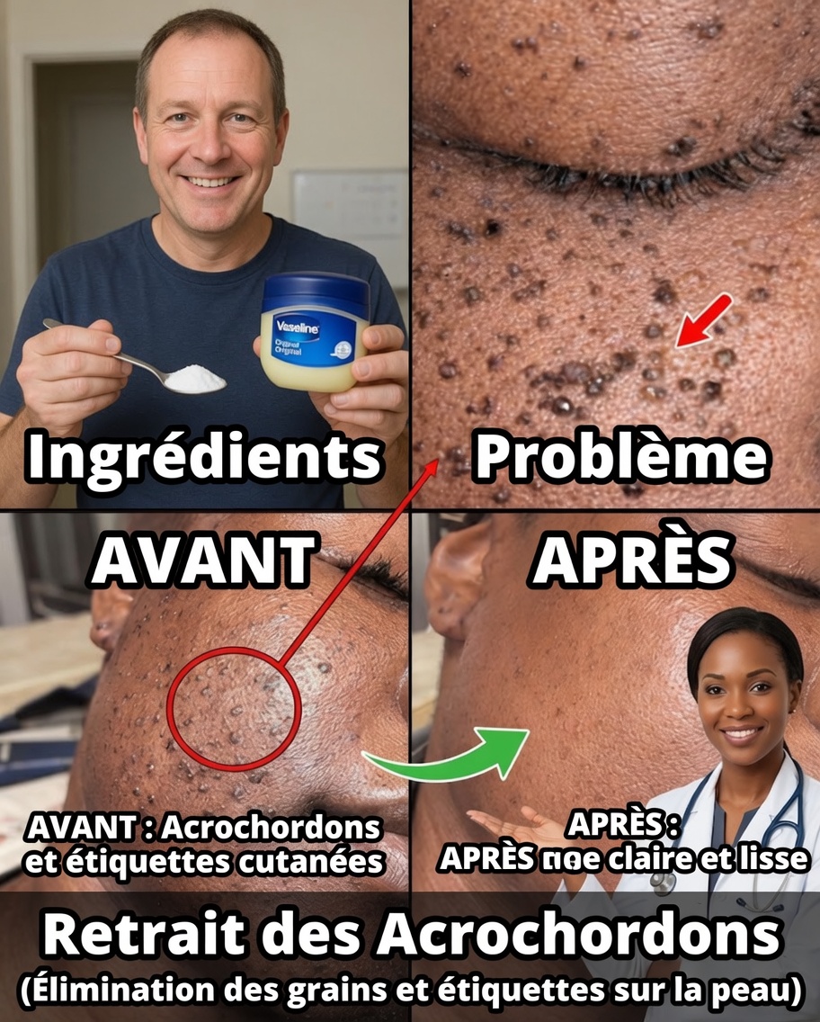 Ces Petits Points Blancs Tenaces : Comment Comprendre les Grains de Milium et Améliorer Votre Peau en Toute Sécurité