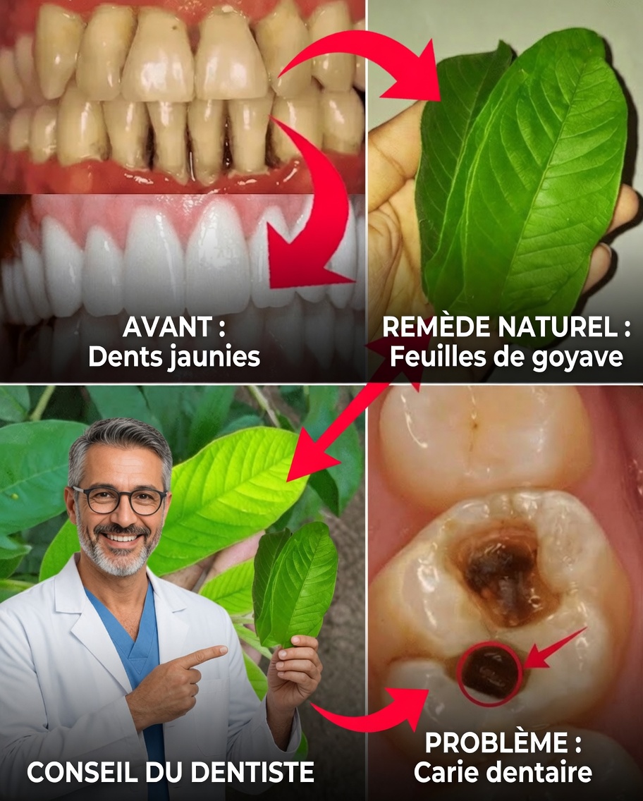 3 façons simples et économiques de traiter la carie dentaire avec des feuilles de goyavier
