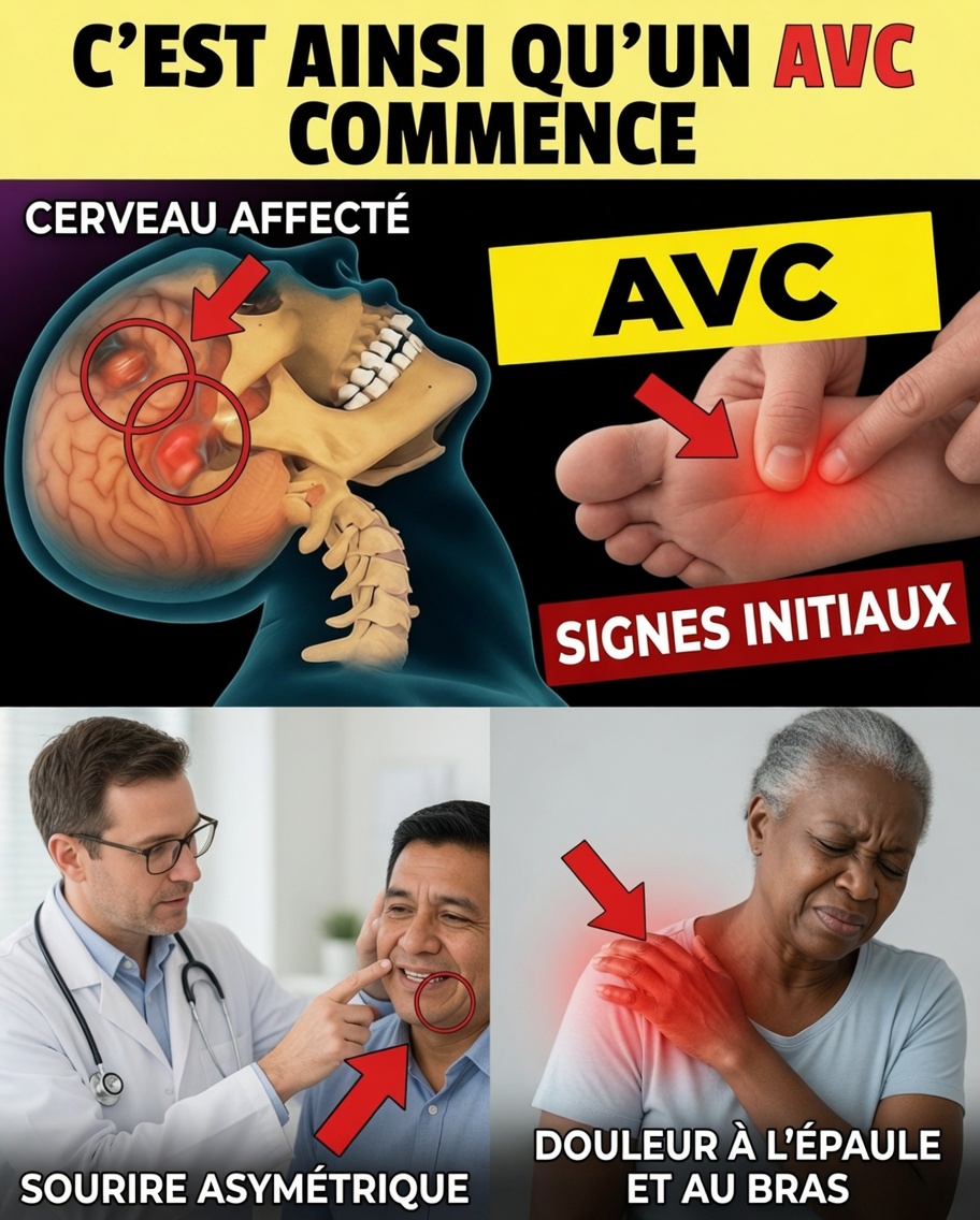 8 Signes d’alerte d’un AVC que vous pouvez remarquer avant qu’il ne soit trop tard
